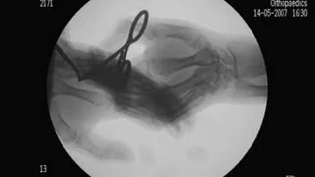 Удаление инородного тела смотреть онлайн