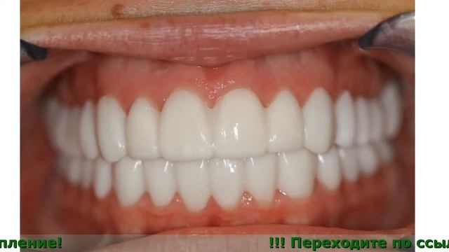 Виниры Snap-On Smile Отзывы смотреть онлайн