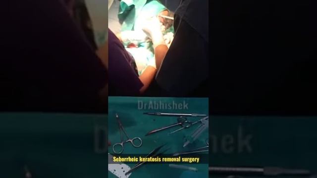 Seborrheic keratosis removal surgery #surgery #drabhishek смотреть онлайн