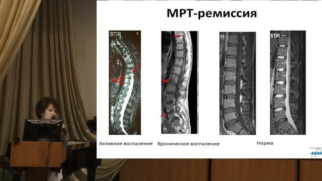 Дубинина Т.В.: Ремиссия, как цель терапии болезни Бехтерева - Школа для пациентов в Калининграде смотреть онлайн