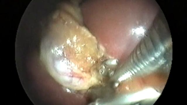 Первая в России трансвагинальная холецистэктомия смотреть онлайн