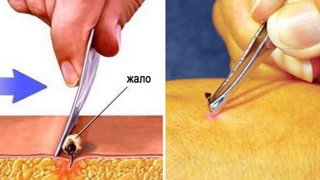 Как вытащить жало пчелы смотреть онлайн