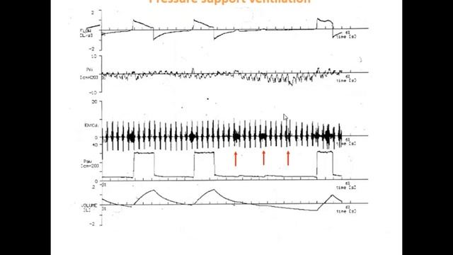 12 Patient ventilator interaction Brochard Laurent (ARF-18)
