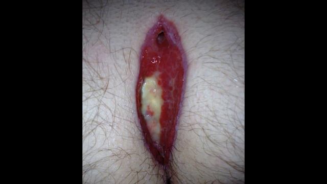 Pilonidal Cyst: Open wound healing смотреть онлайн