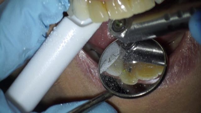 Fotona Lightwalker Laser Painless Composite Filling смотреть онлайн