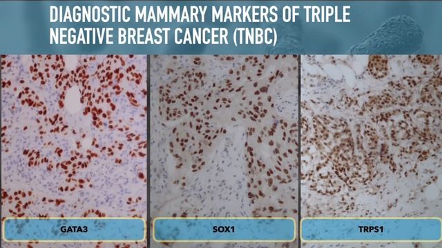 USA - Dr. Hadi Yazji - Molecular Profiling of Breast Cancer Clinically Oriented Approach смотреть онлайн