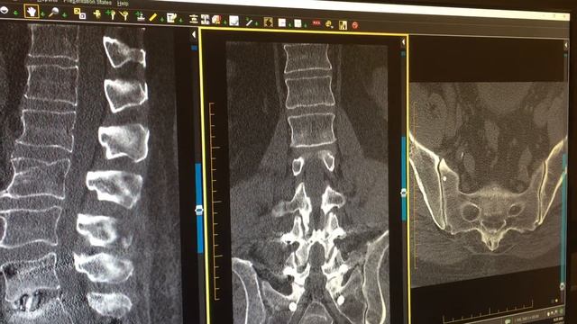 improvement after OLLIF, now SI joint disease, which is adjacent level to L5/S1, смотреть онлайн