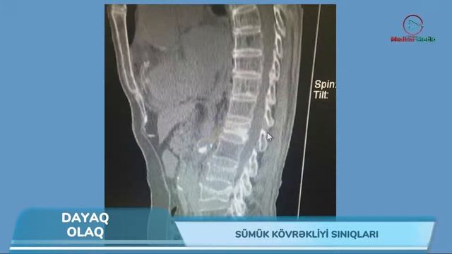 Dayaq olaq - Sümük kövrəkliyi sınıqları смотреть онлайн