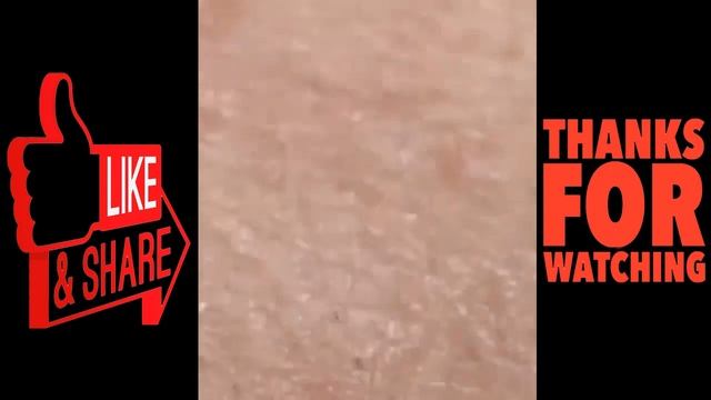 Blackheads Remove,pimples Removal,acne Removal Treatment,dr Pimple Popper Nose 2021 #15