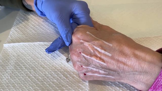 Radiesse dermal filler for Hands смотреть онлайн
