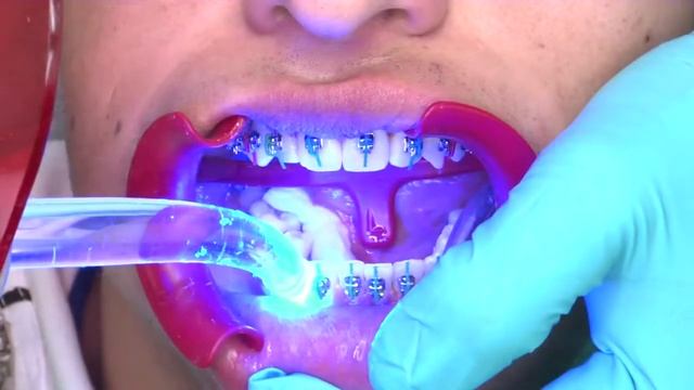 Ormco Colombia: líderes en ortodoncia a nivel mundial - Brackets dentales de calidad смотреть онлайн