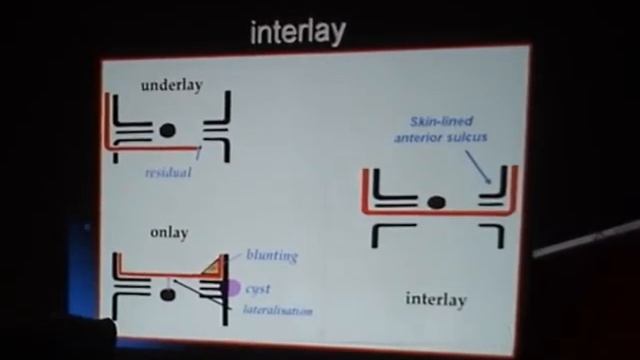 Tympanosclerosis - Dr.A.B.R.Desai смотреть онлайн