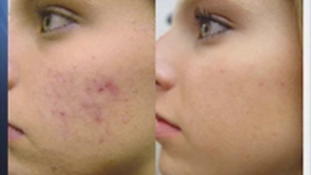 Acne Treatment with Fotona Laser смотреть онлайн