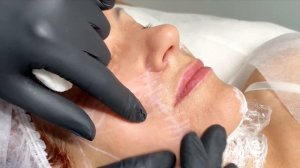 Процедура коллагена NITHYA при коррекции возрастных изменений методом инъецирования  SKIN BOOSTING.