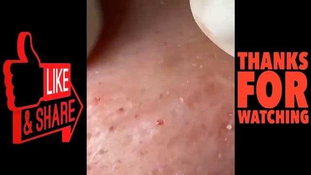 blackheads remove,pimples removal,acne removal treatment,dr pimple popper nose 2021 #16 смотреть онлайн