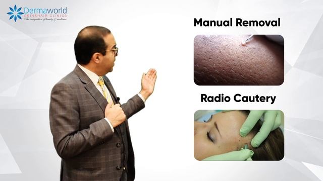 Molluscum Contagiosum Treatment | Dr Rohit Batra смотреть онлайн