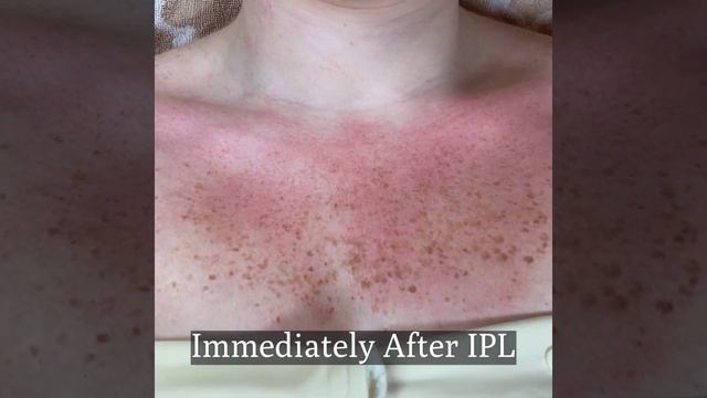 IPL Before and After RESULTS FACE AND CHEST смотреть онлайн