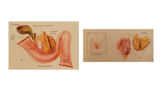 Karim Sarhane MD - Learning Module: Whipple Procedure step by step смотреть онлайн