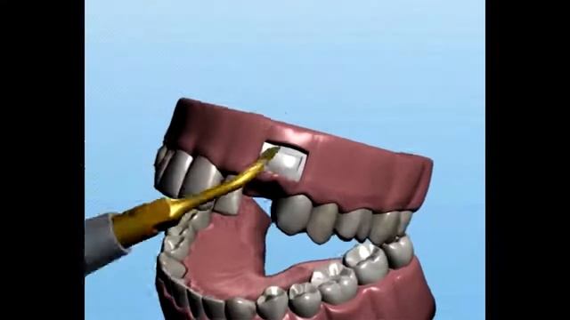 Применение насадок для хирургического ультразвукового аппарата Ultrasurgery DS II LED смотреть онлайн