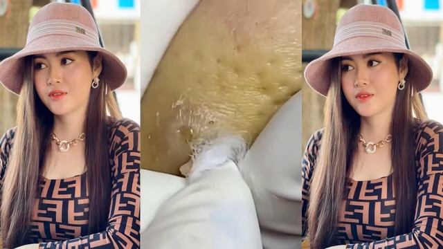 Best Bleckheads,Blackheads Removal,Blackhead Extractions, Выдавливание черных точек прыщей 2022