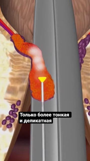 LHP. Лазерное удаление геморроидального узла #shorts смотреть онлайн