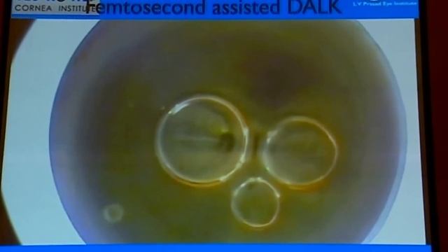 AIOC2018 - IC433 - Topic - Femto Second Laser Assisted Lamellar Keratoplasty смотреть онлайн
