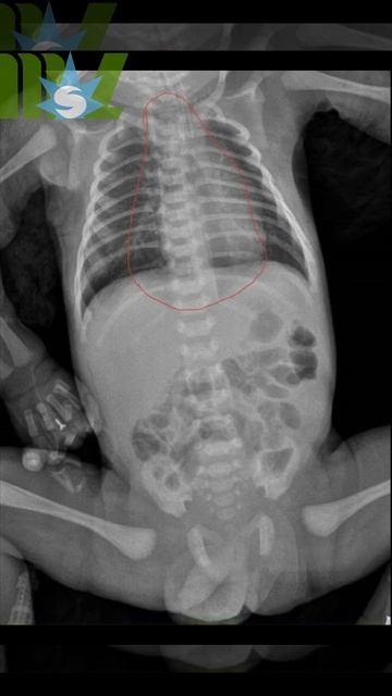 How to identify pneumothorax in newborn and mediastinal emphesema? смотреть онлайн