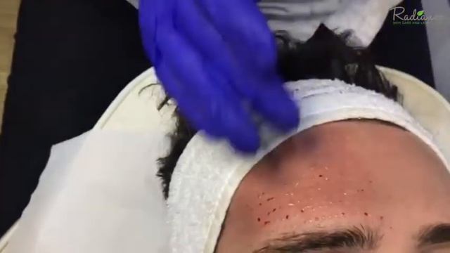 Mesotherapy Treatment | Radiance Skincare and Laser Clinic | Balham | смотреть онлайн