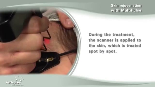 Fractional skin rejuvenation with the MultiPulse CO2 laser by Asclepion 1 смотреть онлайн
