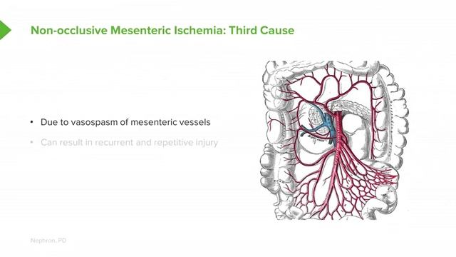 3.07 Mesenteric Ischemia- Epidemiology смотреть онлайн
