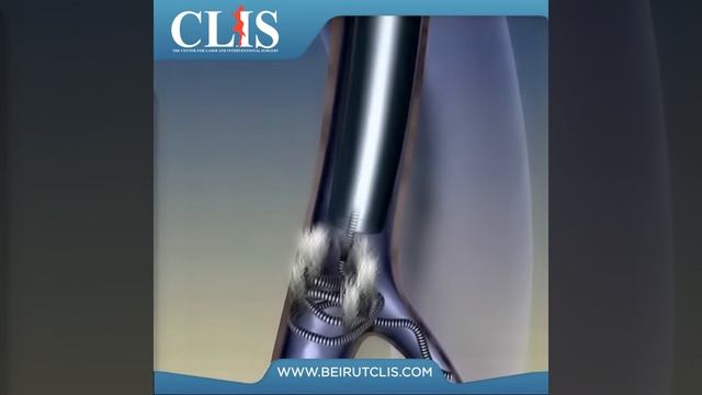 Varicocele Embolization