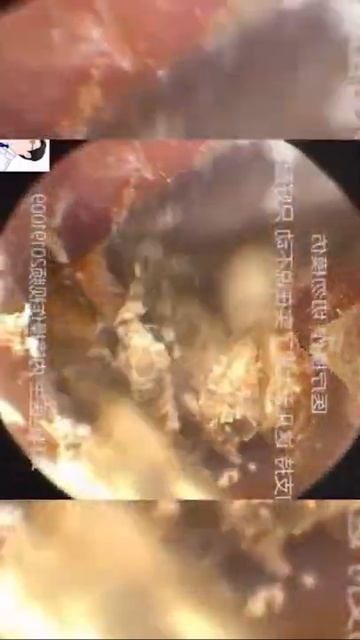 Best Ear Wax Removal & Extraction with Vacuum Remover 真空リムーバーによるにきびの除去と抽出 79 смотреть онлайн