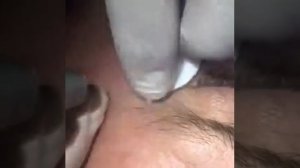 Лазерное удаление базалиомы