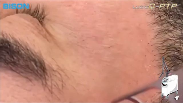 BISON MEDICAL Lucid Q-PTP 1064nm / 532nm Q-Switched Nd:YAG Laser смотреть онлайн