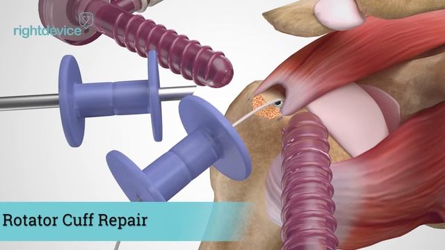 What Is A Rotator Cuff Repair and How Is It Performed? смотреть онлайн