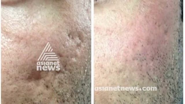 Laser Treatment for skin | ലേസര് ചികിത്സ | Doctor Live 9 April 2018 смотреть онлайн