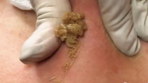 Remoção de cravo 2021 - Pimple Popping 2021 -Blackhead Removal  EP008