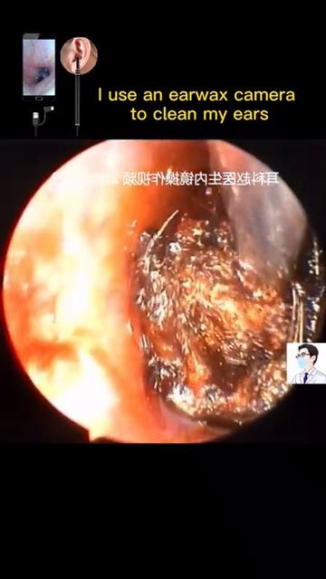 Best Ear Wax Removal & Extraction with Vacuum Remover 真空リムーバーによるにきびの除去と抽出 67 смотреть онлайн