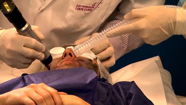 ALMA-Q laser Carbon peel demo at IMCAS - Alma Lasers смотреть онлайн