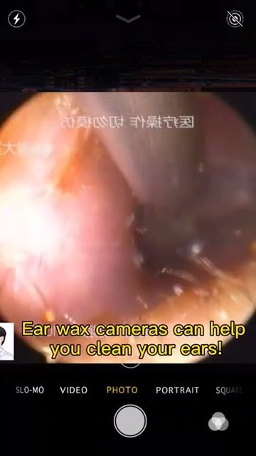 Best Ear Wax Removal & Extraction with Vacuum Remover 真空リムーバーによるにきびの除去と抽出 17 смотреть онлайн