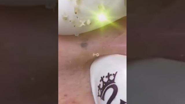 Чистка лица. смотреть онлайн