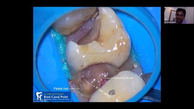 Impact of "root canal anatomy" in treatment outcome смотреть онлайн