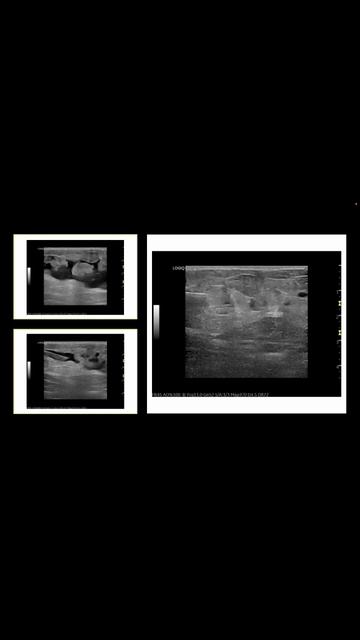 Ultrasound Guided Interventions: Cases (Morelle Lavelle Lesion) #ultrasound смотреть онлайн