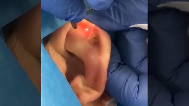 laser CO2 cheloide orecchio смотреть онлайн