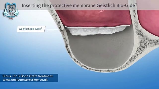 Sinus Lifting Bone Grafting Surgery at Smile Center Turkey, Antalya смотреть онлайн