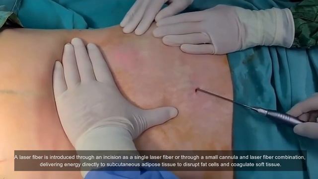 Portable Mini 980nm Diode Laser Lipolysis Instrument-TRIANGEL MINI 60 смотреть онлайн