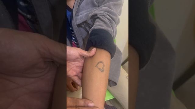 tattoo removal new modality: Fractional co2 + QS ND-YAG laser смотреть онлайн
