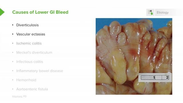 2.10 Gastrointestinal Bleeding (GI Bleed) смотреть онлайн