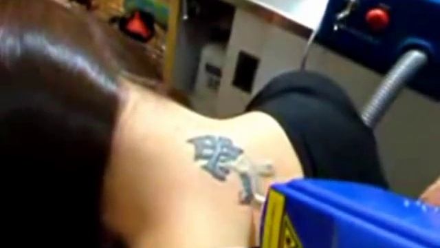 MINI Laser Tattoo Removal Q-Switched Nd: YAG Laser. смотреть онлайн