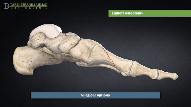 Bunion surgery - surgical treatment of hallux valgus (subtitled) смотреть онлайн